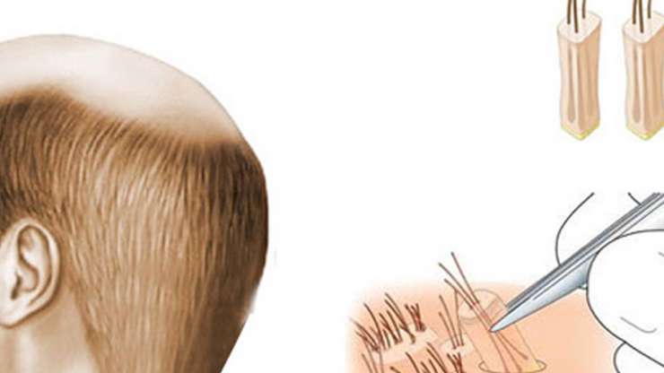 5 things you must know before hair transplant
