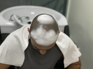 How to wash your head after hair transplant