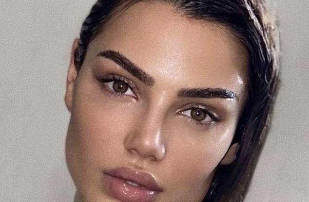 Natural and Long term lip augmentation