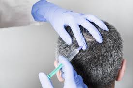 Hair Mesotherapy is the method of injecting the appropriate medicine under the hairy skin