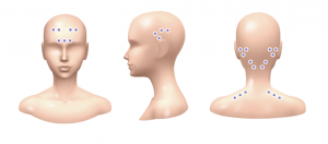 injection areas