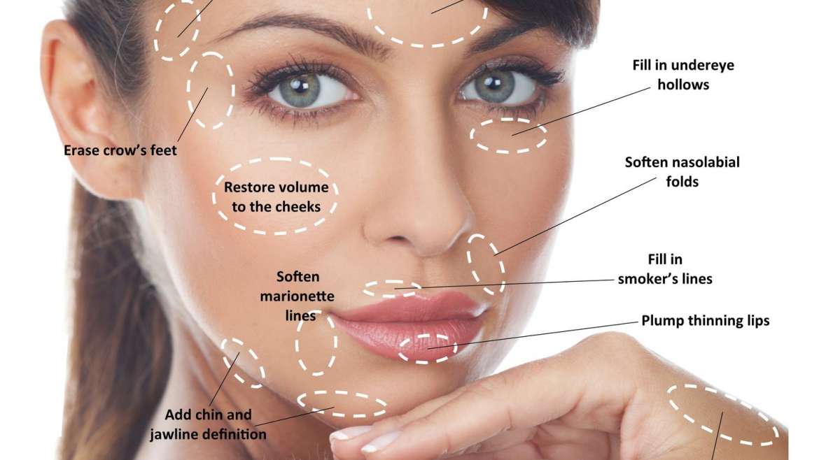 Temples Filler at Alanya Aesthetic